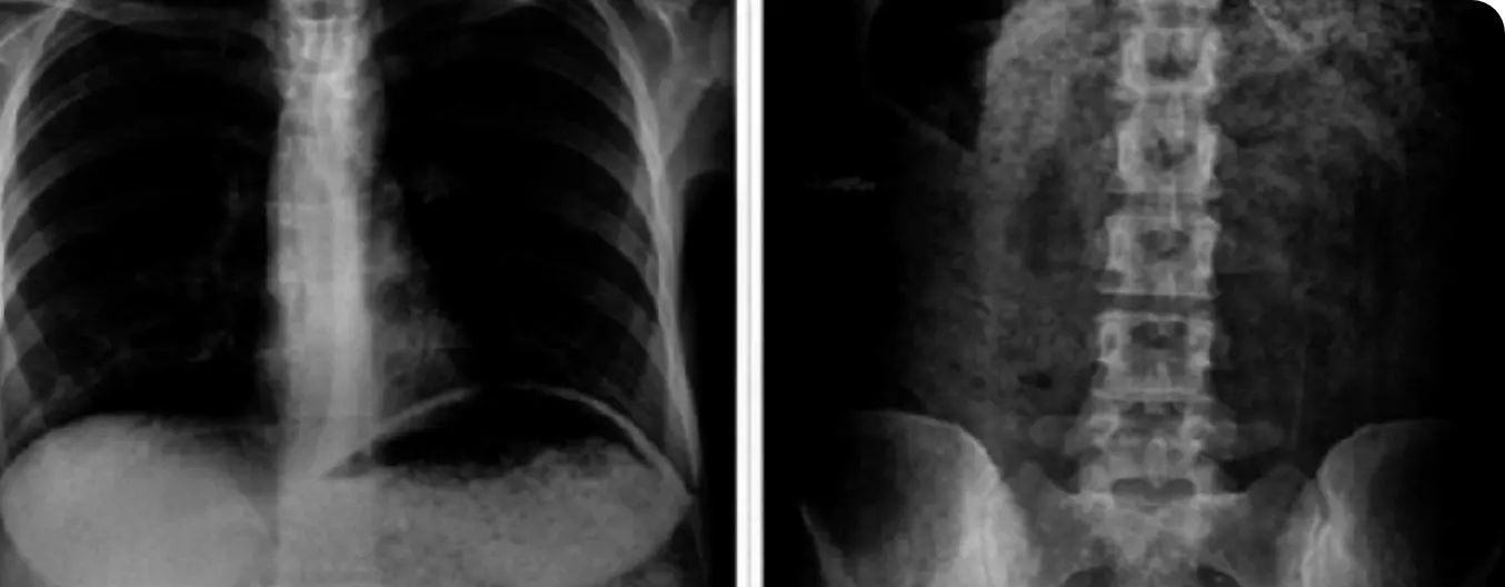 Fusión Lumbar Anterior (ALIF)